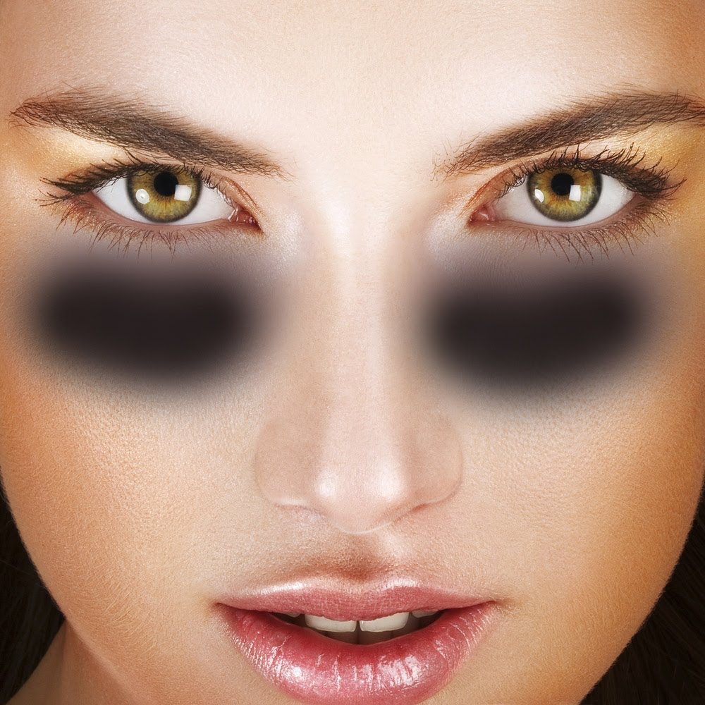 göz altı morlukları, göz altı morluğu tedavisi, lazerle göz altı morluğu tedavisi